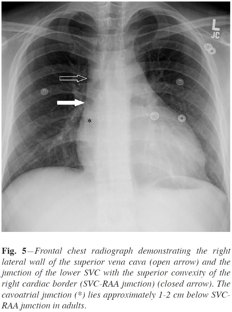 anatomía del cxr