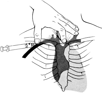 Subclavian Insertion Position